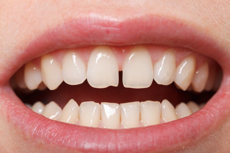 https://elshenawy-dentalclinics.com/wp-content/uploads/2025/07/Gapped_teeth__1601686731_20364.jpg