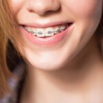 درباره درمان های ارتودنسی فانکشنال چه می‌دانید؟