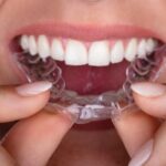 نگهدارنده یا ریتینر ارتودنسی چیست و چه کاربردی دارد؟