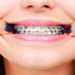 ارزیابی نیاز به ارتودنسی در کودکان