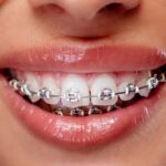ارتودنسی متحرک بهتر است یا ارتودنسی ثابت؟