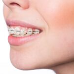 اوربایت چیست و چگونه ارتودنسی می تواند به طور موثر آن را درمان کند؟