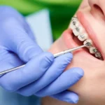 ۱۰ سوال مهم قبل از اقدام به درمان ارتودنسی چیست؟