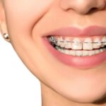 ارتودنسی در بزرگسالان؛ تا چه سنی میتوان دندانها را مرتب کرد؟