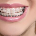 ارتودنسی قبل از ایمپلنت؛ چرا بعضی بیماران باید ابتدا ارتودنسی شوند؟